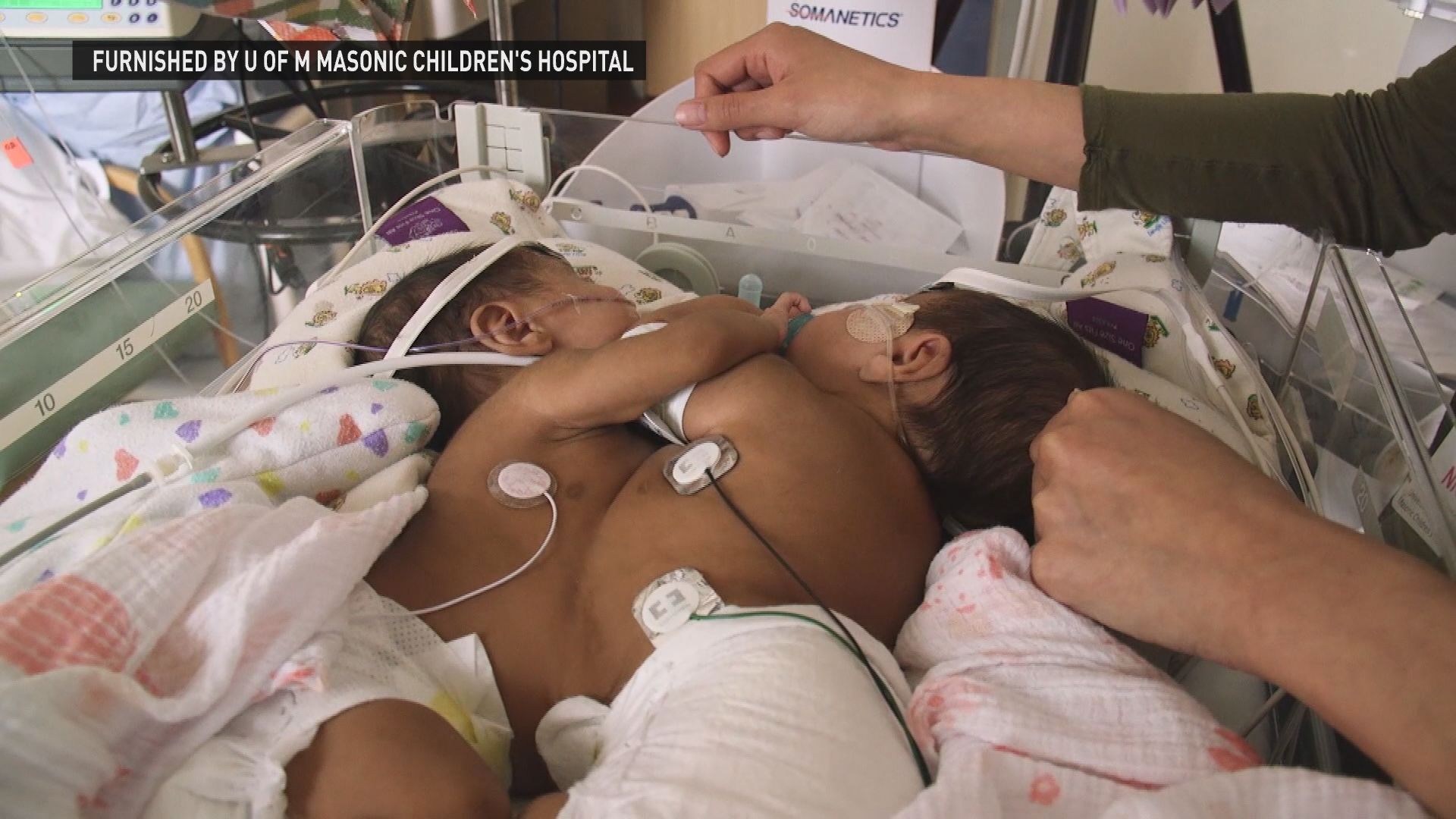 Conjoined twins separated with help...