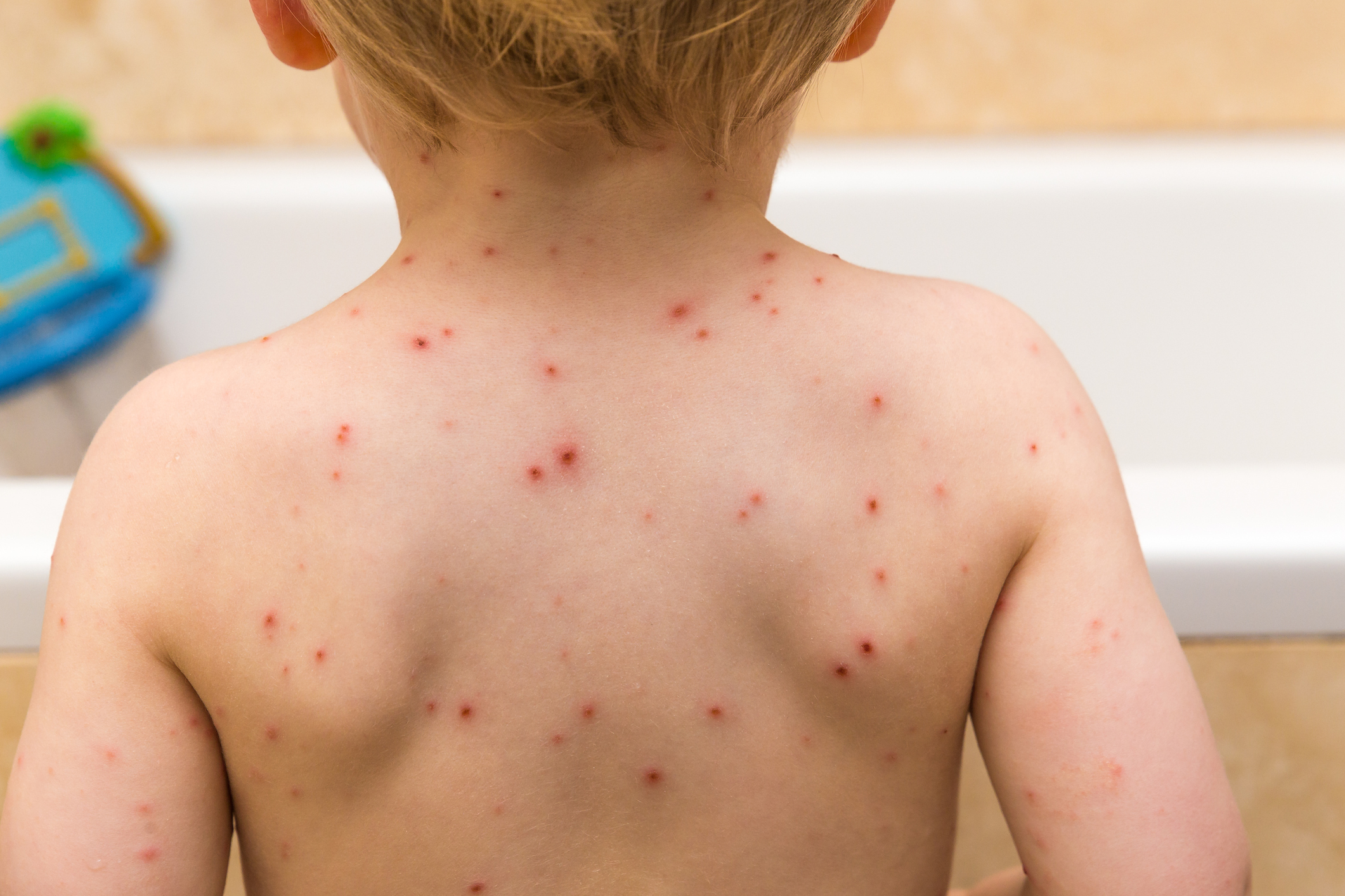 kare11-390-cases-of-chicken-pox-reported-in-mn-this-year